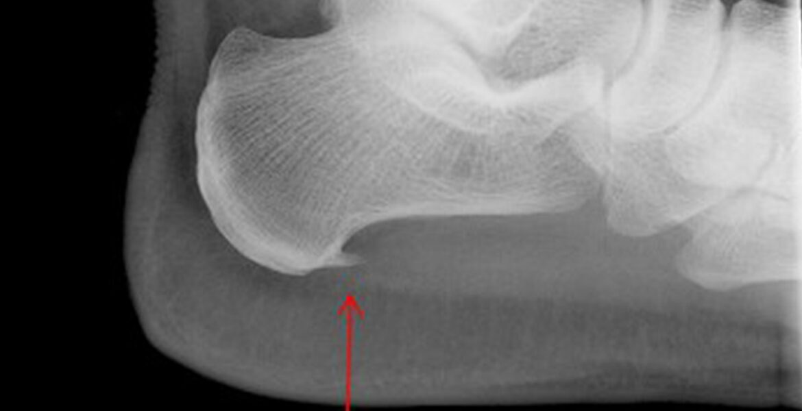 Curvy Girls watch out for the Plantar Fascitis!